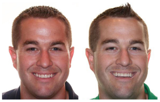Before and after treatment with Invisalign of a man