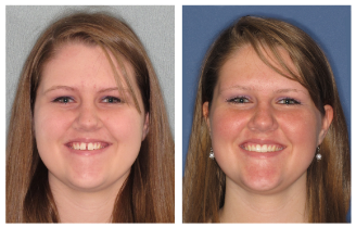 Woman's before and after Invisalign treatment