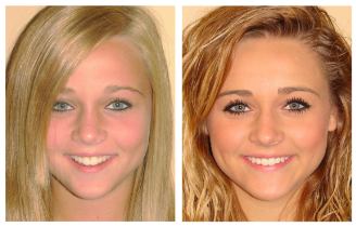 Young woman's smile before and after Invisalign
