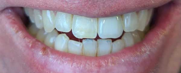 before and after case 2 - after